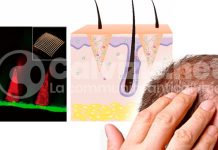 La cura della calvizie sarà un antiandrogeno? microaghi