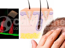 La cura della calvizie sarà un antiandrogeno? microaghi