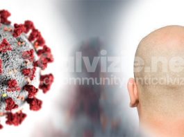 Calvizie da Covid e nuove terapie coronavirus e calvizie