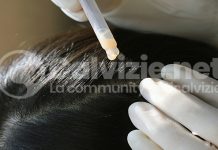 Terapie della calvizie: nuova classifica? terapie della calvizie: nuova classifica?