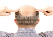 Due dita possono predire la calvizie? Calvizie e rapporto indice/anulare