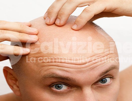 Calvizie: forse non tutti sanno che… Calvizie: forse non tutti sanno che…