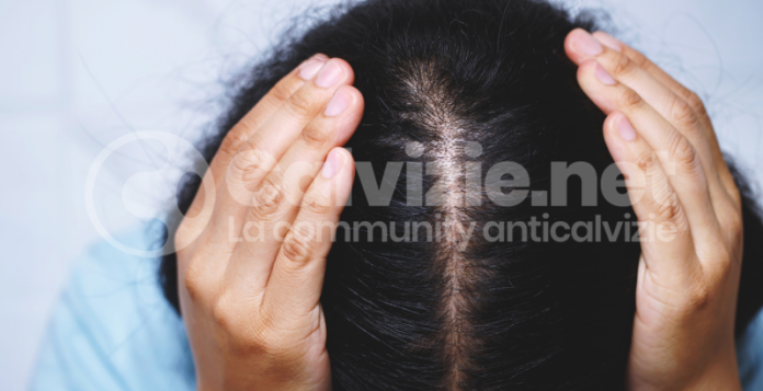 alopecia androgenetica femminile