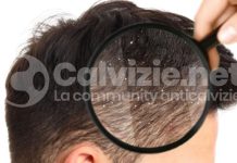 Capelli grassi rimedi: parla il dott. Fantini