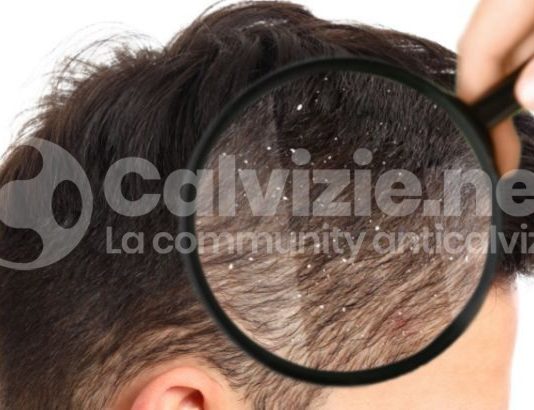 Capelli grassi rimedi: parla il dott. Fantini