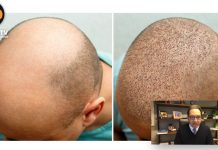 L’importanza del post-trapianto capelli: intervista al dott. Tesauro