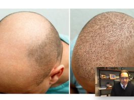 L’importanza del post-trapianto capelli: intervista al dott. Tesauro