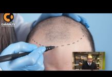 Trapianto capelli chirurgo, aspettative e responsabilità: parla Tesauro