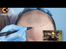 Trapianto capelli chirurgo, aspettative e responsabilità: parla Tesauro